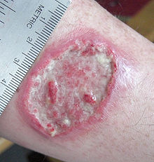 http://upload.wikimedia.org/wikipedia/commons/thumb/6/6e/Leishmaniasis_ulcer.jpg/220px-Leishmaniasis_ulcer.jpg